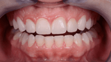Biofilm Discloser