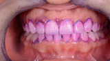 Biofilm Discloser